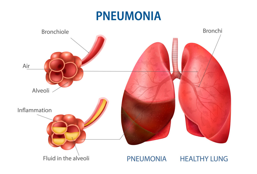 pneumonia